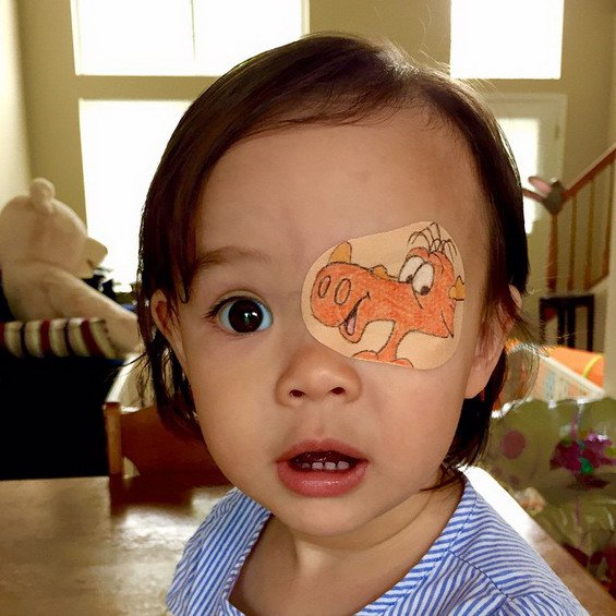 This Little Girl Has to Wear an Eyepatch! Her Dad Makes It Fun For Her On The Most Adorable Way