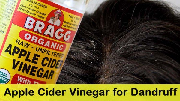 9 Of The Best And Most Useful Home DIY Hacks To Get Rid Of Dandruff And Itchy Scalp