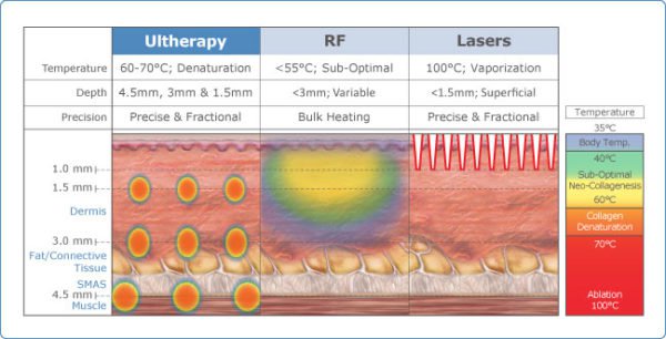 Tightening Your Skin with Ultrasound Therapy Versus Lasers