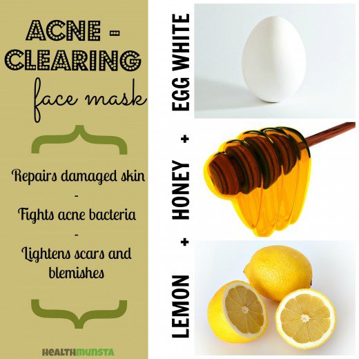 Natural Anti Acne Face Masks That