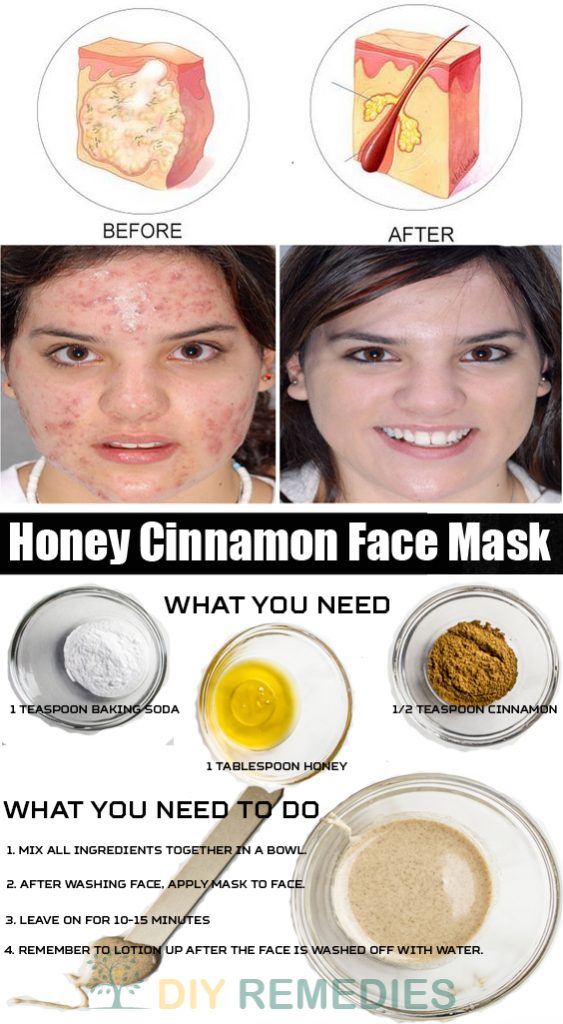 The Most Effective And 100% Natural Anti Acne Face Masks That Everybody Should Try