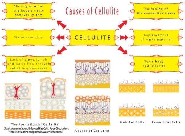 Causes Of Cellulite And Natural Ways  To Get Rid Of It And Start Your Healthy Life Routine