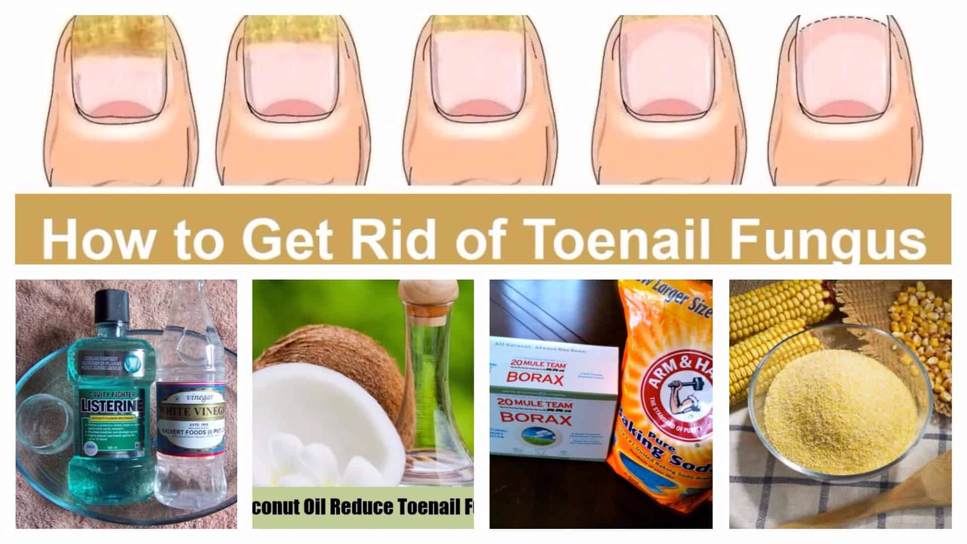 Useful Homemade Remedies For Toe Nail Fungi ALL FOR FASHION DESIGN