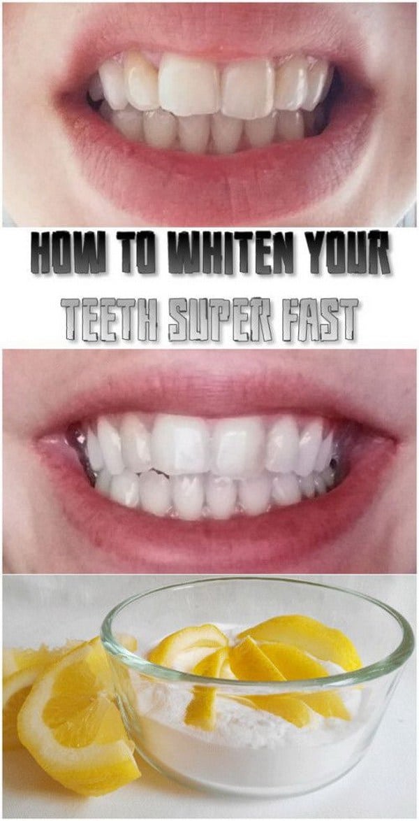 Most effective teeth whitening at home