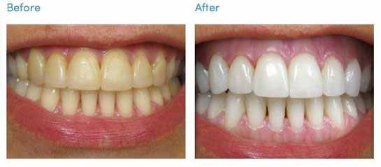 Effective Homemade Remedies For Teeth Whitening That You Should Try Now