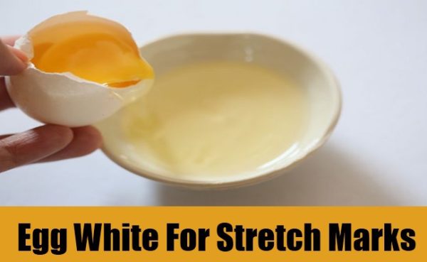 Get Rid Of Stretch Marks Naturally