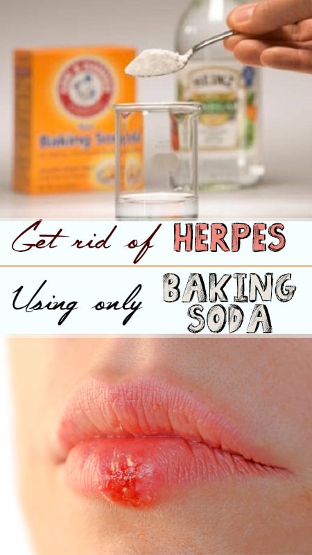 Effective Homemade Remedies To Cure Herpes