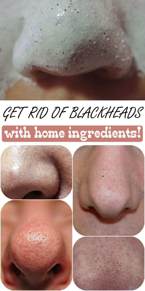 Awesome Homemade Blackheads Removers That Are Easy To Make ALL FOR