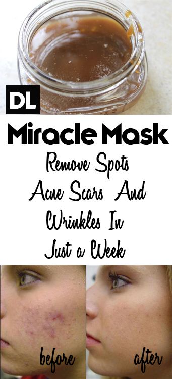 Homemade Creams That Will Help You Remove Scars On Your Face