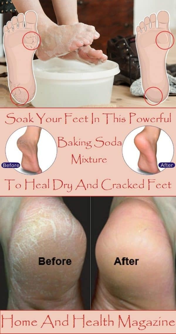 Powerful Cracked Heels Remedies That Are Worth A Try