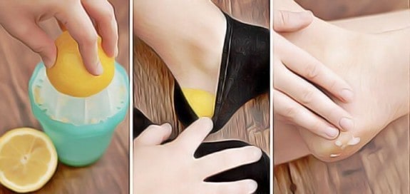 Powerful Cracked Heels Remedies That Are Worth A Try