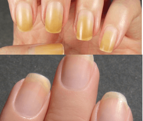 Effective Homemade Nail Whitening Ideas That You Should Try Now