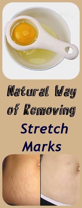 Natural Homemade Stretch Marks Remedies To Use After Pregnancy