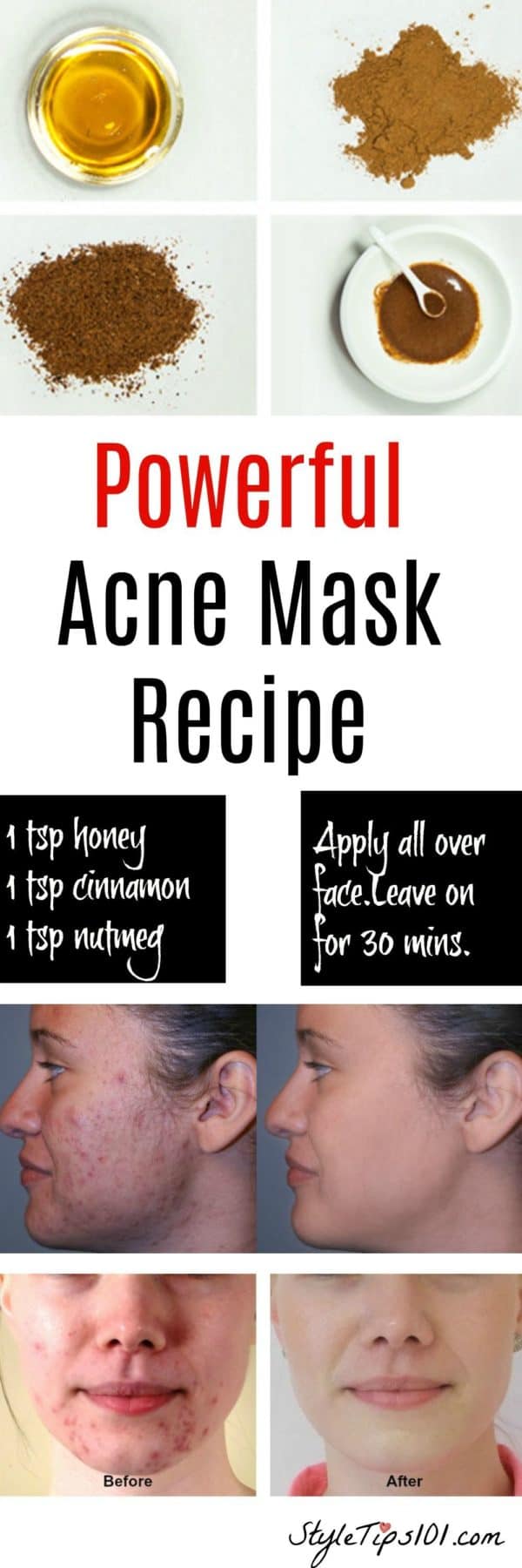 Amazing Homemade Acne Remedies That You Have To Try Now