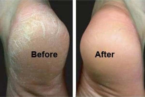 Best Treatment For Cracked Heels