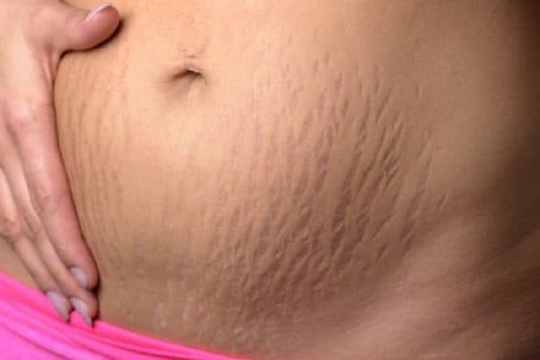 Natural Homemade Stretch Marks Remedies To Use After Pregnancy