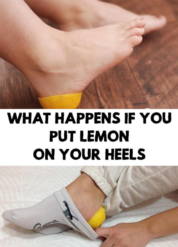 Homemade Remedies That Will Get Your Cracked Heels Ready For Summer