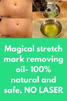 Natural Homemade Stretch Marks Remedies To Use After Pregnancy