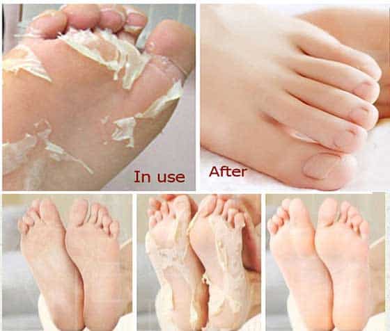 Homemade Remedies That Will Get Your Cracked Heels Ready For Summer