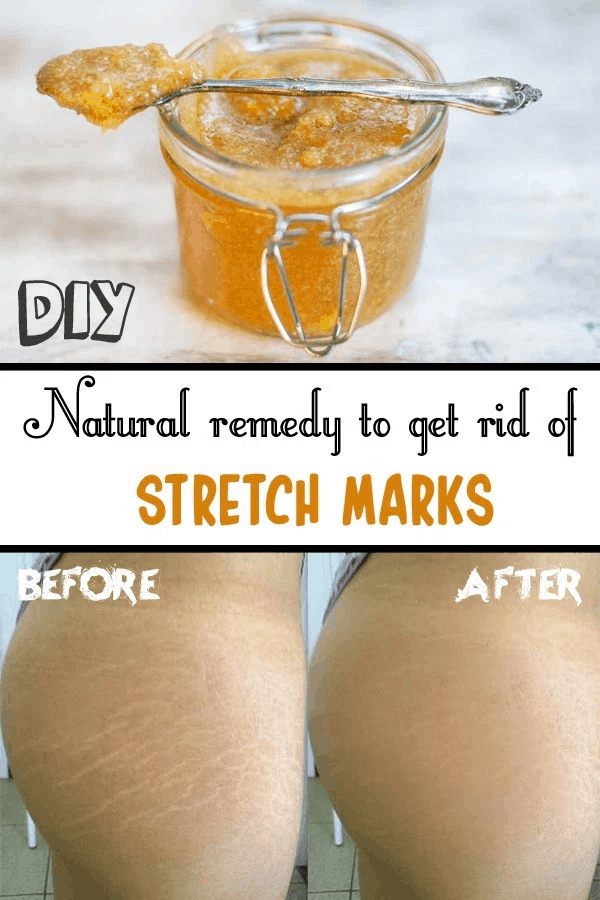 Natural Homemade Stretch Marks Remedies To Use After Pregnancy