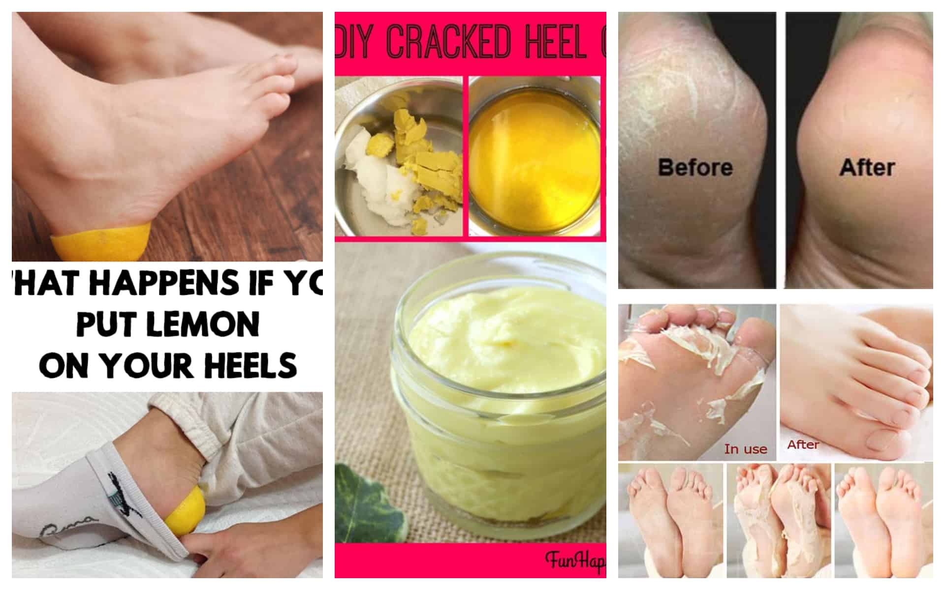 Prevention And Home Remedies For Cracked Heels - Women On Top