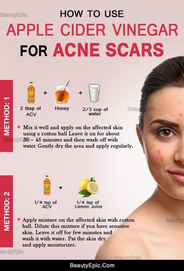 Amazing Homemade Acne Remedies That You Have To Try Now