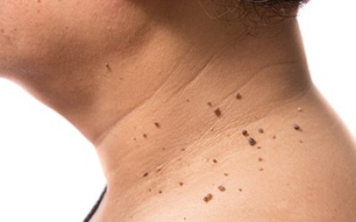 Natural And Safe Ways To Get Rid Of Unwanted Skin Warts