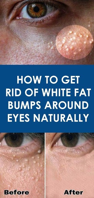 Natural Ingredients Recipes To Get Rid Of White Bumps Around Eyes