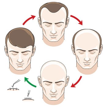 How do hair transplants work