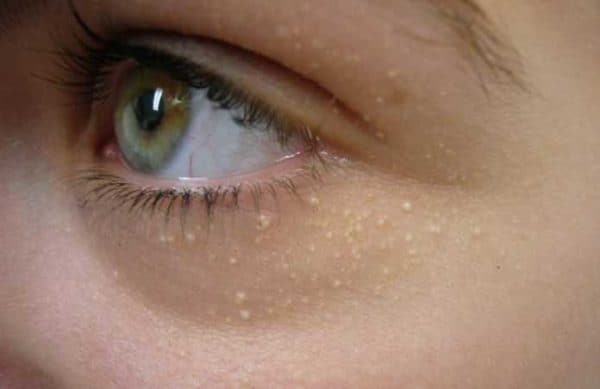 Natural Ingredients Recipes To Get Rid Of White Bumps Around Eyes