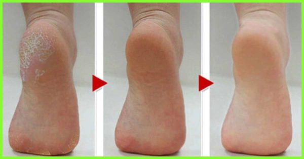 get rid of foot cracks