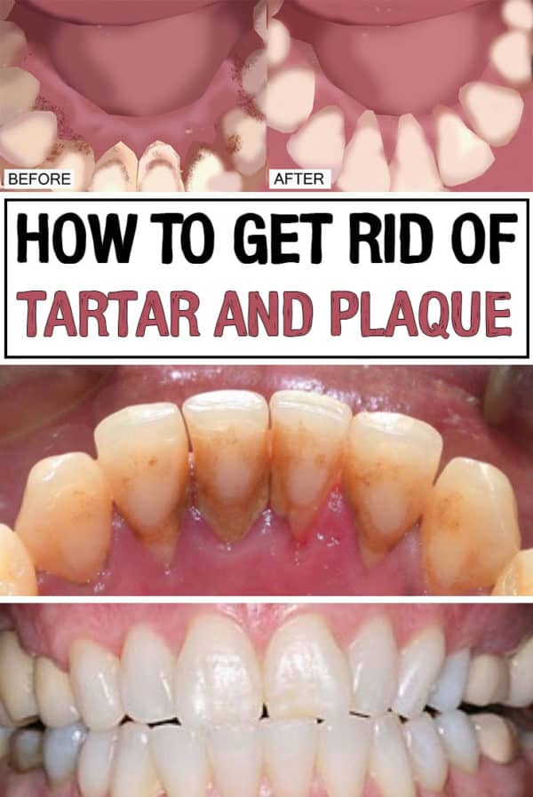 Natural Ways To Get Rid Of  Tartar And Plaques That We All Must Try