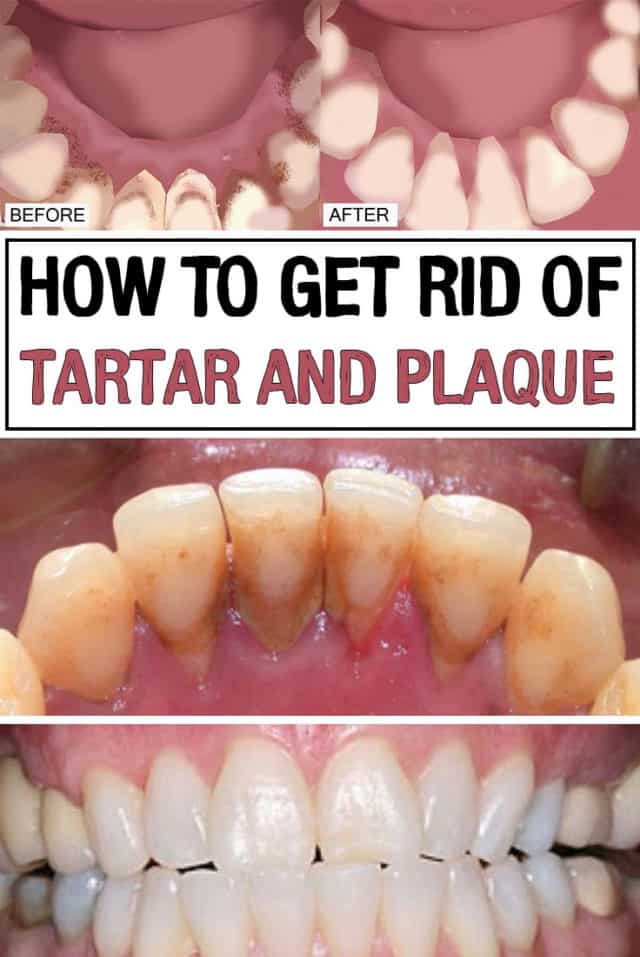 Natural Ways To Get Rid Of Tartar And Plaques That We All