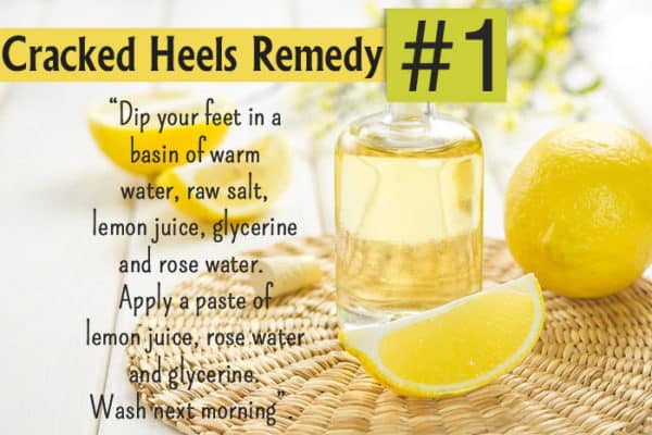 Homemade Recipes To Get Rid Of Cracked Leg Feet