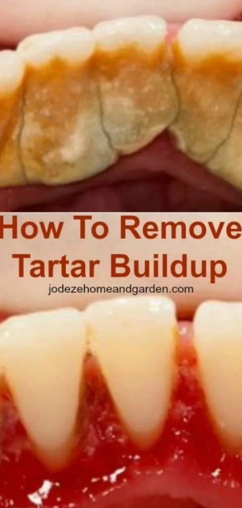 Natural Ways To Get Rid Of  Tartar And Plaques That We All Must Try