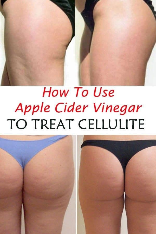 Natural Ways To Get Rid Of The Annoying Cellulite At Home