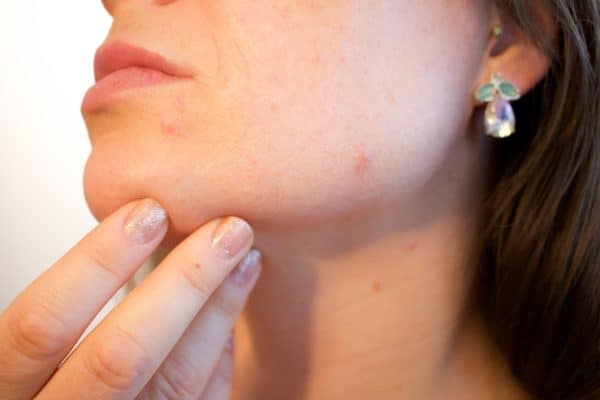 Treating Acne Scars: Should you DIY?