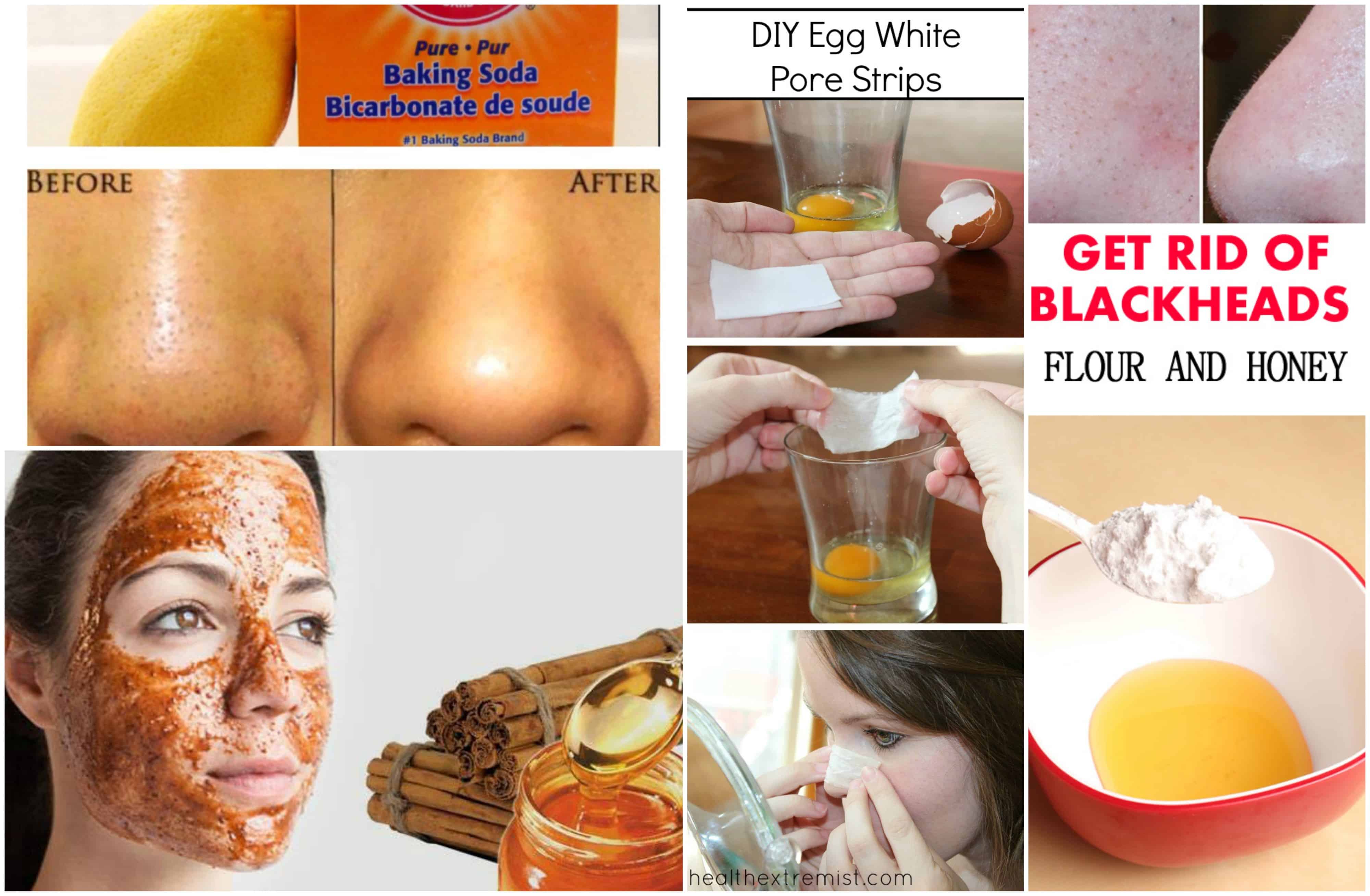 how to get rid of blackheads homemade remedies