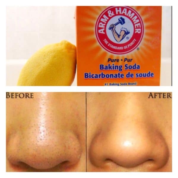 The Most Effective Homemade Remedies To Get Rid Of Blackheads