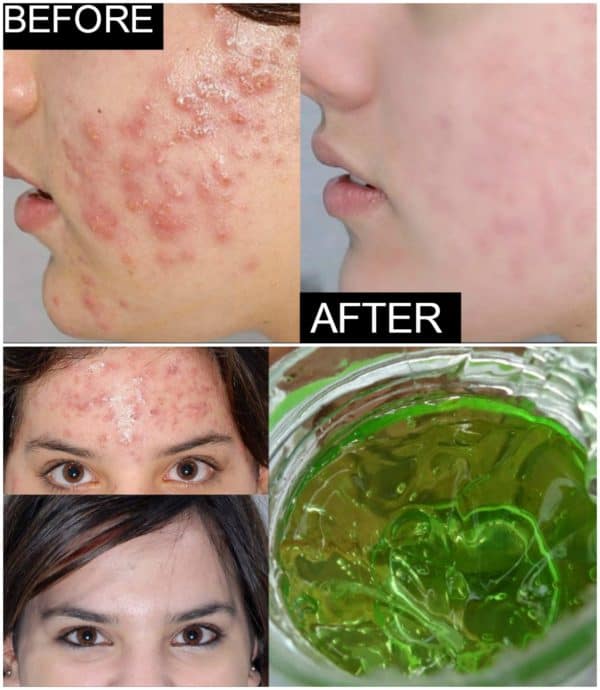 Effective Homemade Aloe Vera Acne Remedies That Will Do Wonders For Your Skin