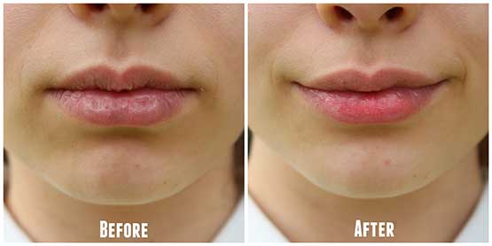 Wonderful Chapped Lips Homemade Remedies That Are Great For The Cold Weather