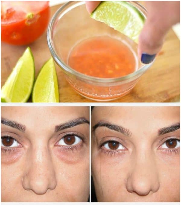 Effective Homemade Remedies For Dark Circles Under Your Eyes