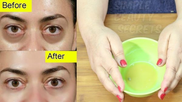 Effective Homemade Remedies For Dark Circles Under Your Eyes