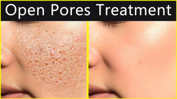 Natural Homemade Open Pores Remedies That Are Very Effective