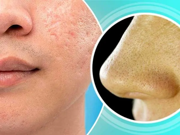 Natural Homemade Open Pores Remedies That Are Very Effective