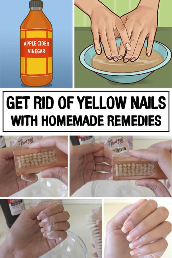 Awesome Homemade Remedies For Yellow Nails That You Should Try