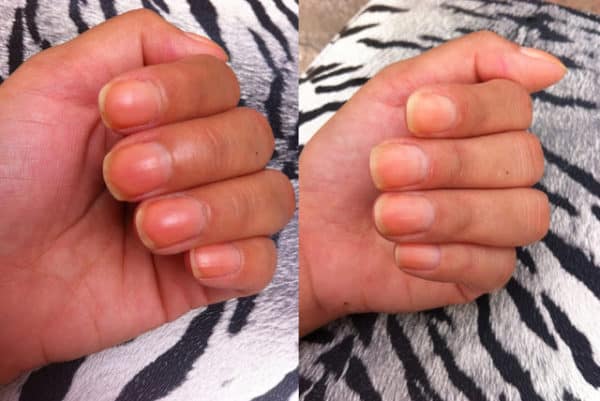 Awesome Homemade Remedies For Yellow Nails That You Should Try