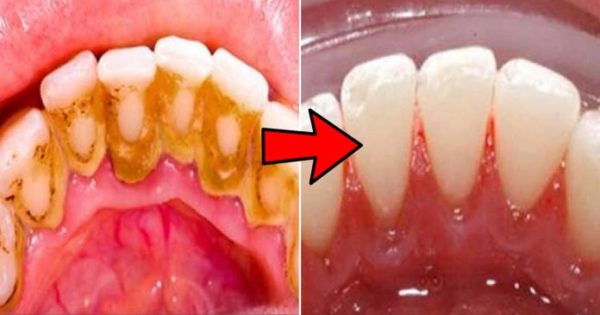 Dental Plaque Homemade Remedies That Will Whiten Your Teeth