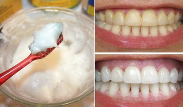 Dental Plaque Homemade Remedies That Will Whiten Your Teeth