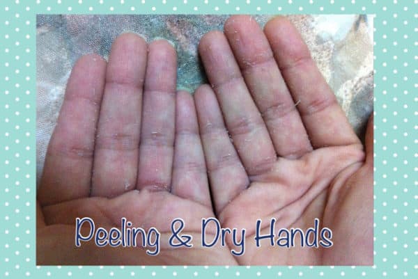 Natural Remedies For Peeling Hands That Are Really Effective
